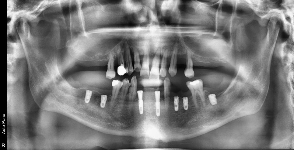 약수역 치과 비염 수술 후 상악동 임플란트 과정 관련 이미지 3