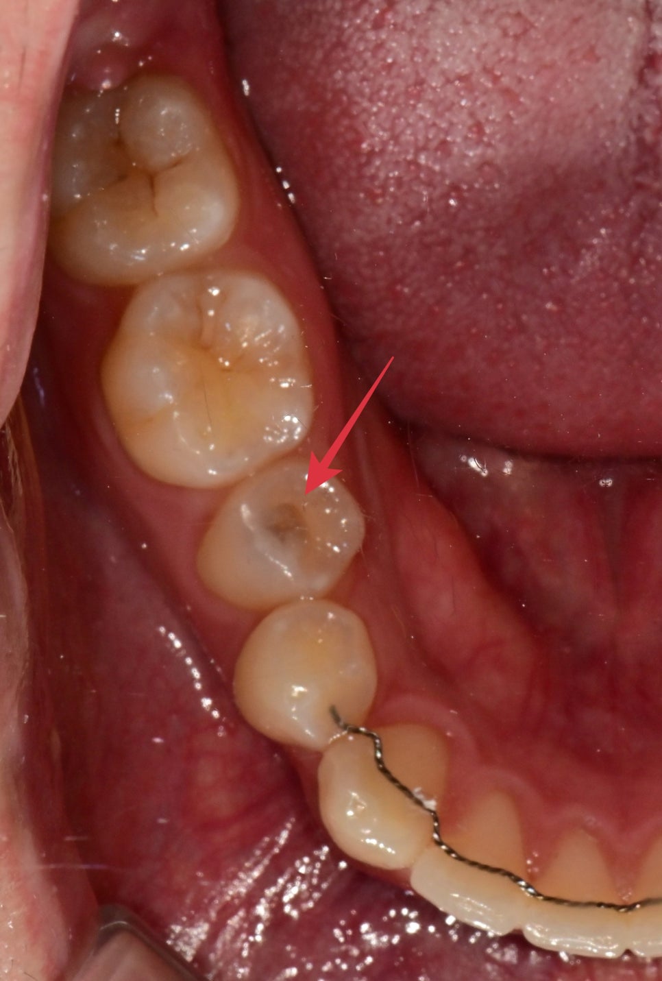 약수역치과 깊은 충치 신경치료 없이 치료하는 방법( MTA치료 ) 관련 이미지 1
