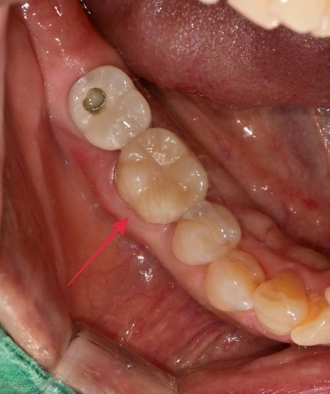 옥수동 크라운치료된 통증 있는 치아의 (재)신경치료 과정 관련 이미지 7
