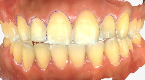 약수역 치과 라미네이트의 완성은 관리에서 시작합니다 관련 이미지 2