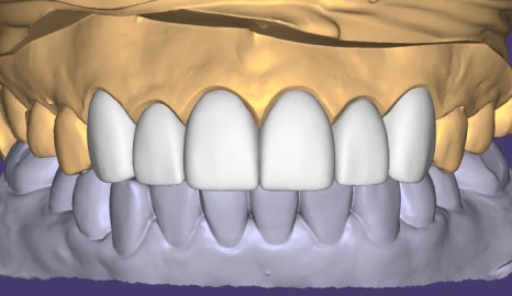 약수역 치과 라미네이트의 완성은 관리에서 시작합니다 관련 이미지 3