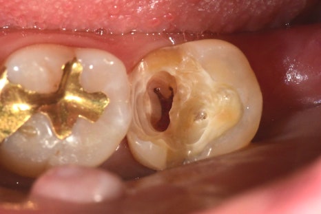 장충동 치과, MTA를 이용한 신경치료 시 주의할 점( 크랙치아, 깊은 충치) 관련 이미지 7