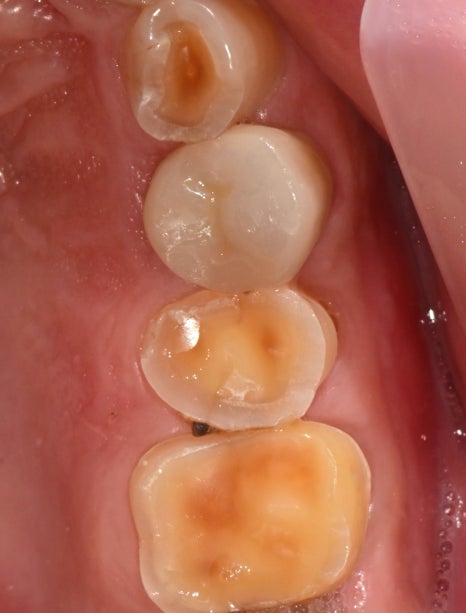 약수역 치과 크랙 치아 (금 간 치아) 관련 이미지 5