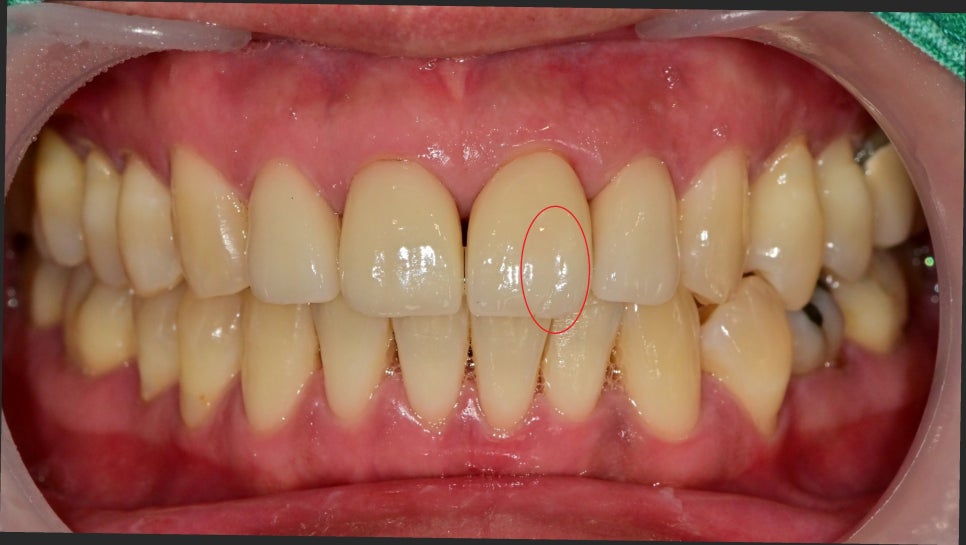 약수역 치과, 전치부 심미 보철 재치료(보철물 파절의 원인) 관련 이미지 1