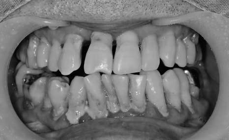 청구역 치과 치주염으로 다수의 치아가 흔들리는 경우(발치, 임플란트) 관련 이미지 2