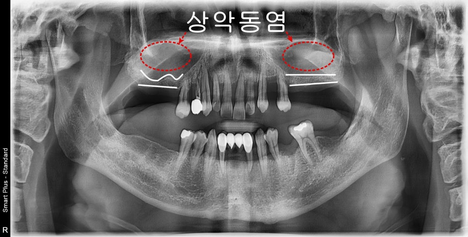 약수역 치과 비염 수술 후 상악동 임플란트 과정 관련 이미지 1