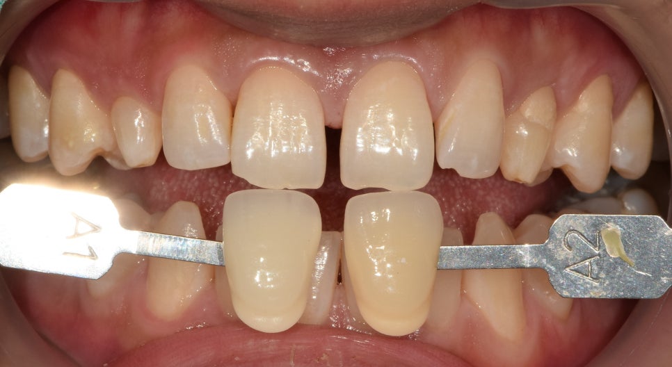 약수역 라미네이트 치과 선천적 왜소치 무삭제 치아 복원 관련 이미지 1