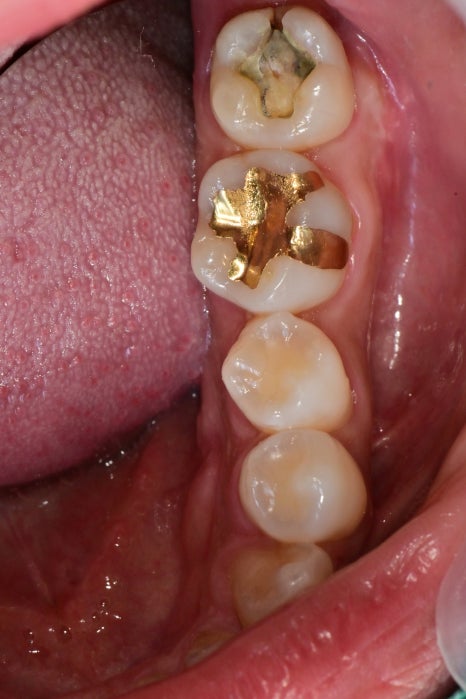 약수역 치과, 어려운 신경형태의 치아 신경치료 할때 주의할점 ( C형 근관, 신경관 찾기, 치아보존치료) 관련 이미지 3