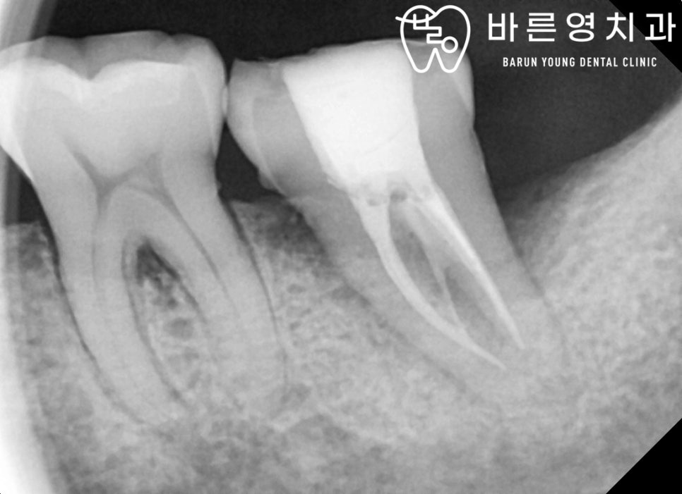 옥수역치과, 충치치료 조기에 해야 자연치아 보존률 UP! 관련 이미지 12
