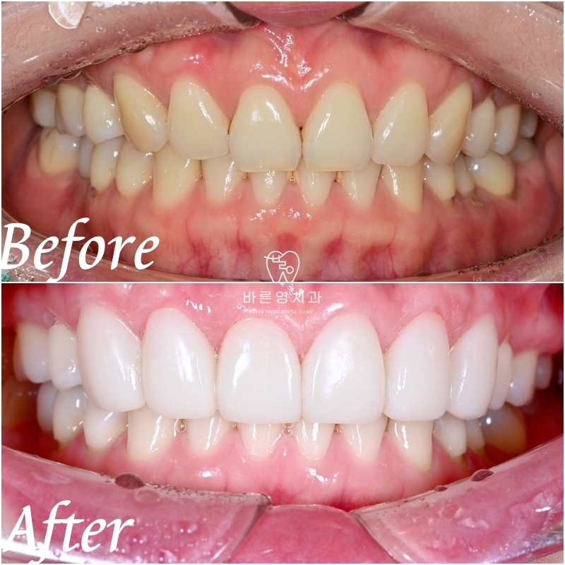 동대문 무삭제라미네이트 과거 교정한 치아가 웃을 때 안 보여 스트레스일 때 관련 이미지 10