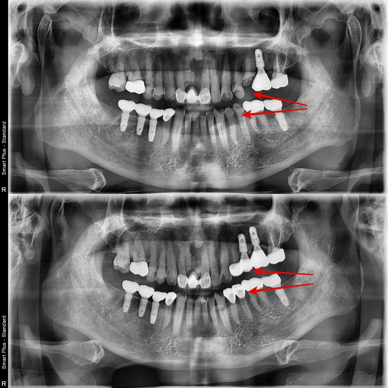 버티고개역 치과 깨지고 닳은 치아 회복하는 방법 관련 이미지 4