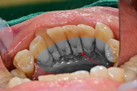 약수역 치과, 양치질 할때 피나고 냄새나는 잇몸병 관리 방법(워터픽, 먹는약) 관련 이미지 8