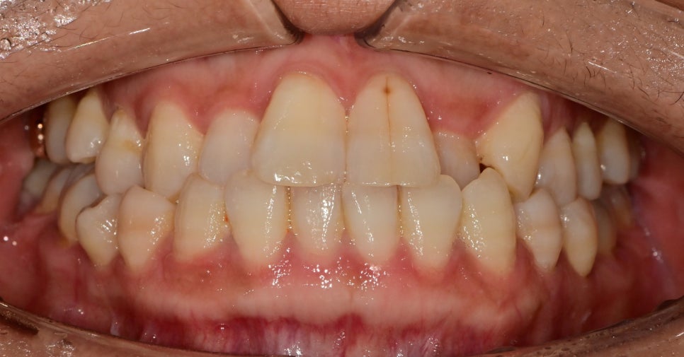 약수역 치과 벌어진 앞니, 금간앞니(크랙) 레진을 이용한 치료 관련 이미지 3