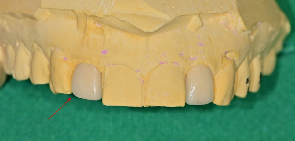 동대입구역 주변 치과 라미네이트가 깨지는 이유 관련 이미지 3