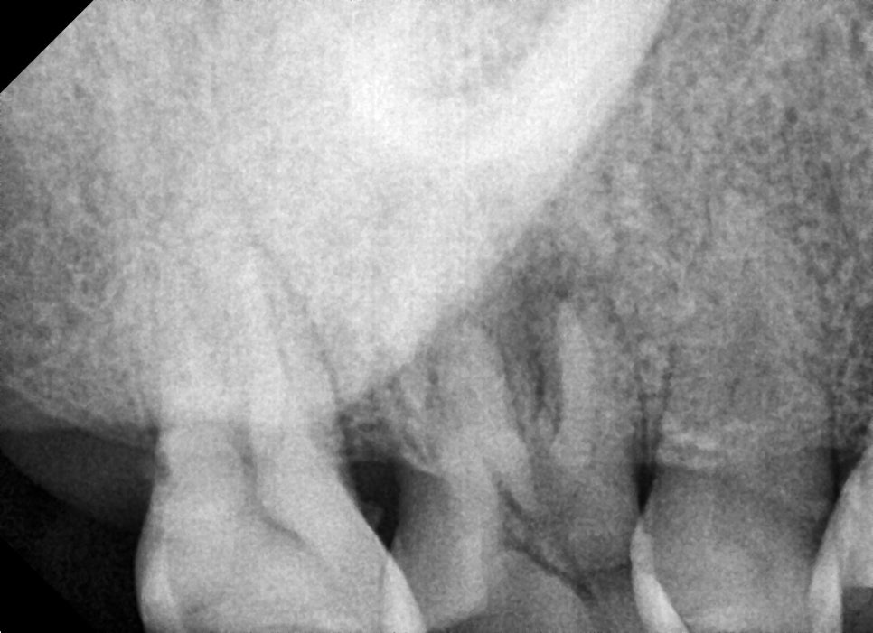 약수역치과, 뿌리염증 치아 신경치료하기( 금 간 치아) 관련 이미지 3