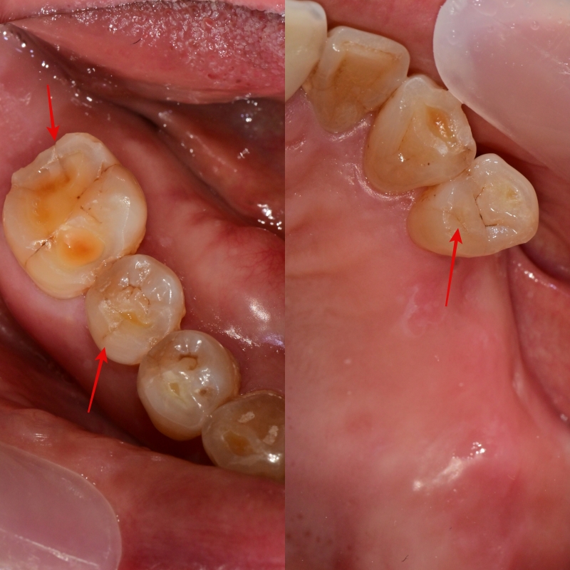 약수 임플란트, 씹을 때 갑작스러운 통증의 원인은? 관련 이미지 3