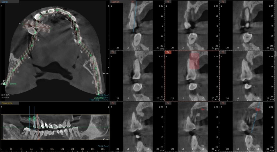 신당역 임플란트 풍치, 심한 치주염인 경우 치과에서 치료 순서 관련 이미지 4