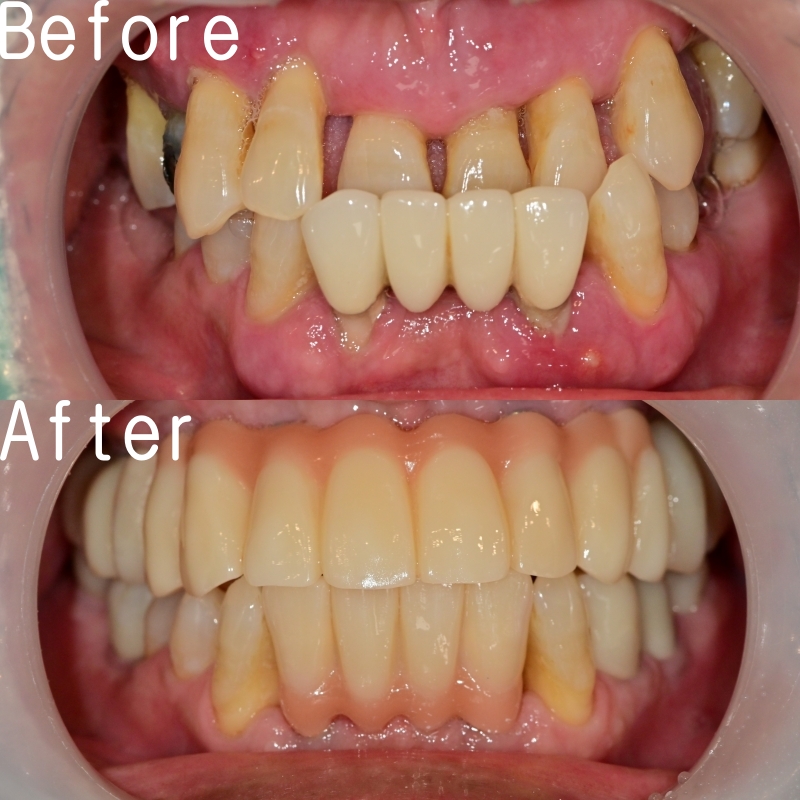 약수역 치과 비염 수술 후 상악동 임플란트 과정 관련 이미지 8