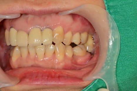 신금호역 주변 치과 치아가 빠진 후 시간이 오래 지나면 생기는 문제점 관련 이미지 4