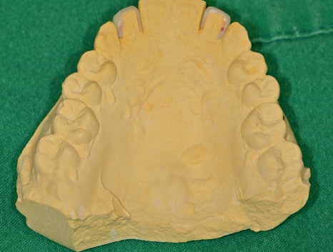 동대입구역 주변 치과 라미네이트가 깨지는 이유 관련 이미지 4