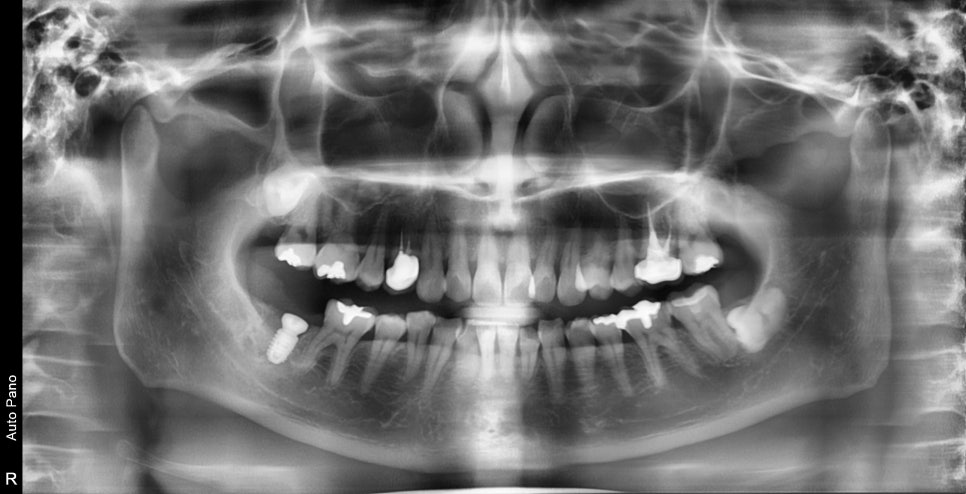 약수역 치과, 금 간 치아( 크랙 치아)로 인한 뿌리 주변 염증이 생겼을 때 치료방법( 임플란트, 치조골 이식술) 관련 이미지 4