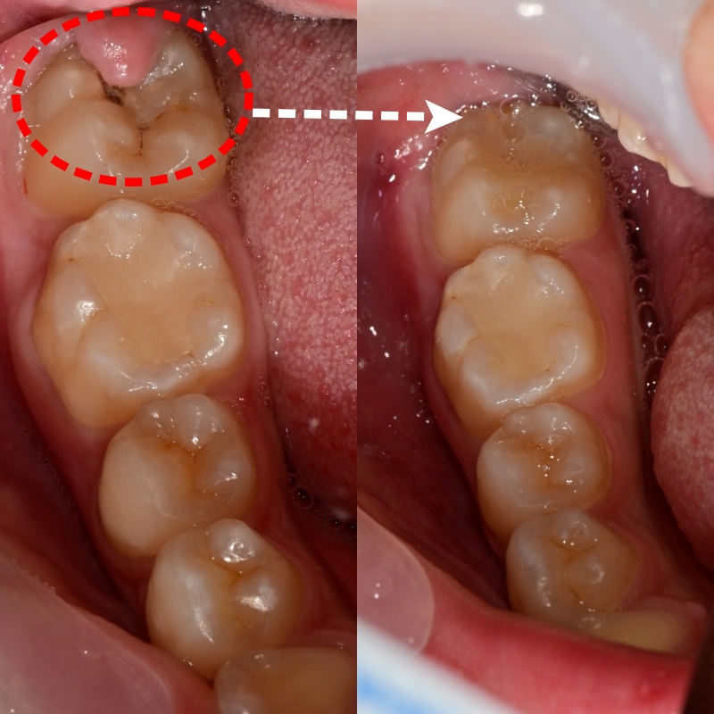 금호동 논골사거리 근처 치과에서 영구치 치료를 위한 잇몸성형술 관련 이미지 1