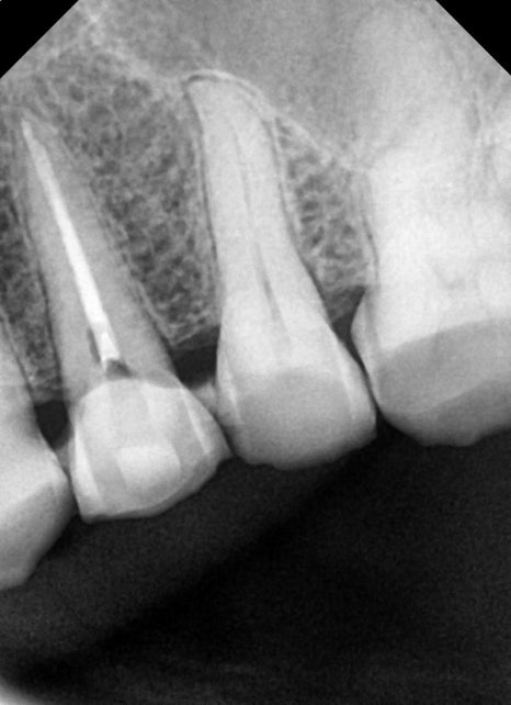 약수역 치과 크랙 치아 (금 간 치아) 관련 이미지 4