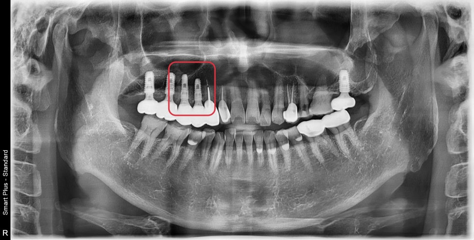 금호동 치과 신경치료된 치아 주변 염증 방치하면 안 되는 이유(발치후 임플란트) 관련 이미지 10