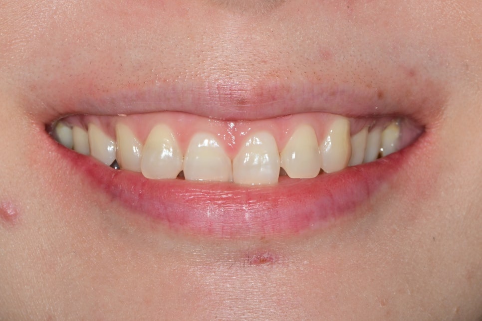 신당 라미네이트 치과 미세삭제로 예쁜 미소 만들기 관련 이미지 2