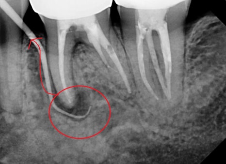 옥수동 치과, 신경치료 돼있는 치아 잇몸의 염증, 고름주머니가 생겼을 때 약을 먹어도 안 가라앉아요. ( 생기는 원인과 치료방법) 관련 이미지 2