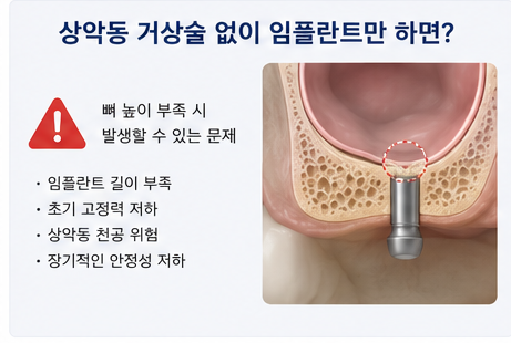 Yak-su Station Dental Clinic: When Is a Sinus Lift Necessary for Implants? image 4