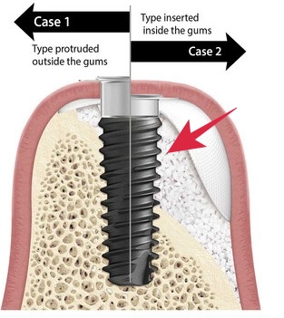 청구역 치과 치주염으로 다수의 치아가 흔들리는 경우(발치, 임플란트) 관련 이미지 7