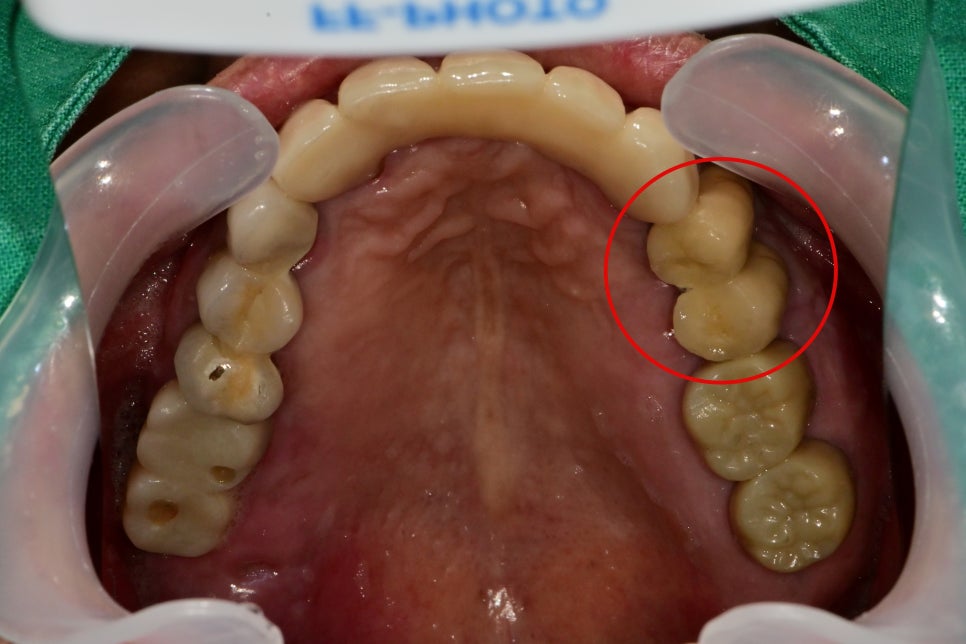 신당동 치과 씹을 때마다 아플 때 임플란트 치아의 문제 관련 이미지 8