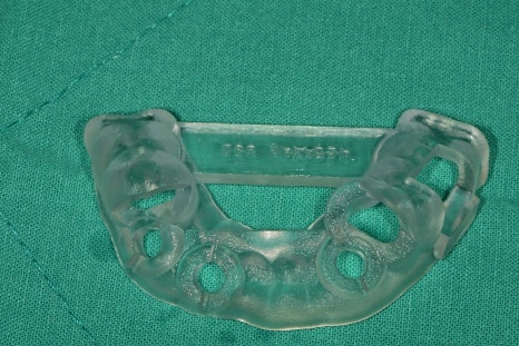 한남동 주변 치과 구강 스캐너를 이용한 가이드 임플란트 수술(무절개 수술) 관련 이미지 4