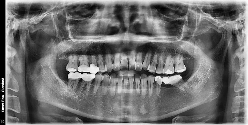 약수역 치과, 금간 치아는 신경치료를 꼭 해야 하나요?( 임플란트 전 크라운치료, MTA) 관련 이미지 7