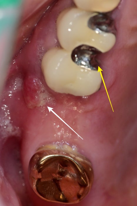 신당 치과 틀니보다 임플란트가 좋은 이유 관련 이미지 2