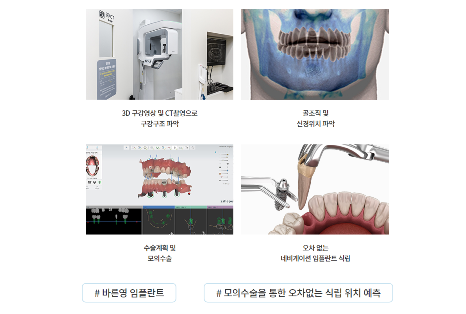 약수역치과, 빠진 치아 그냥 두지 말고 임플란트로 새롭게 관련 이미지 11