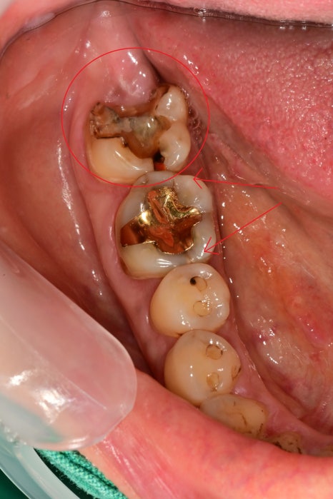 약수역 치과, 금간 치아는 신경치료를 꼭 해야 하나요?( 임플란트 전 크라운치료, MTA) 관련 이미지 3