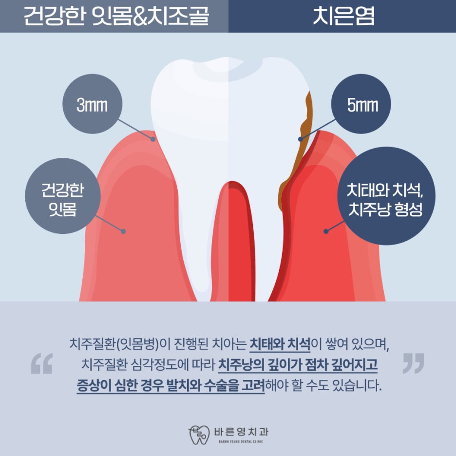 옥수역치과 붓고 피나는 잇몸 치료시기 놓치지 말아야 관련 이미지 5
