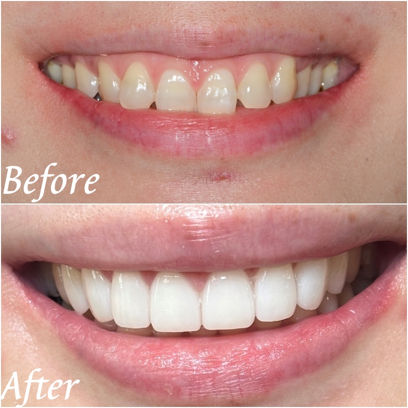 Sindang-dong, Jung-gu: A Dentist’s Honest Explanation of Laminate Veneer Lifespan and Habits That Help Reduce Side Effects image 1