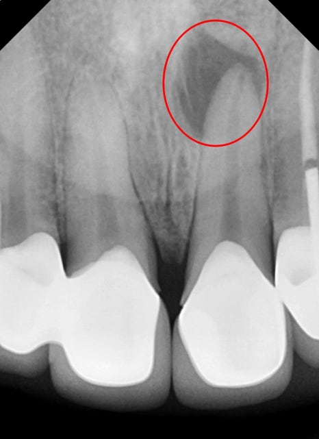신당동 치과, 앞니 보철치료시 주의할 점(심미보철, 신경치료) 관련 이미지 3