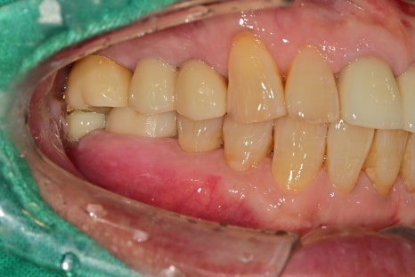 약수 임플란트, 씹을 때 갑작스러운 통증의 원인은? 관련 이미지 7