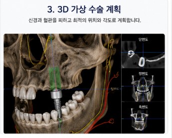 약수역치과 디지털 장비를 이용한 효율적인 임플란트 수술 및 장점 관련 이미지 5