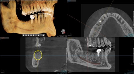 동대문 치아뿌리 염증 방치하면 치과 임플란트 기간에 영향을 줍니다 관련 이미지 6