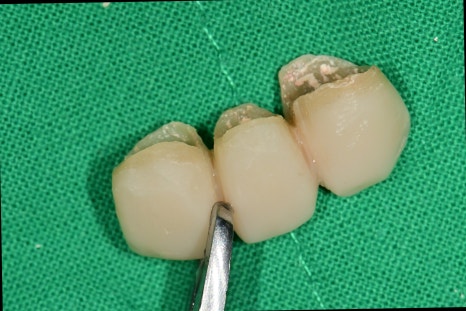 약수역 치과 오래된 앞니 크라운 재보철치료시 주의할 사항 관련 이미지 4