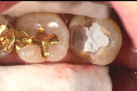 장충동 치과, MTA를 이용한 신경치료 시 주의할 점( 크랙치아, 깊은 충치) 관련 이미지 8