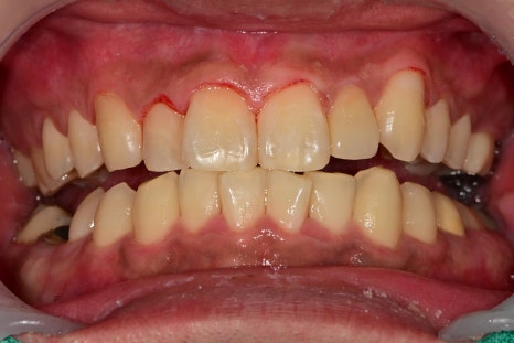 금남시장 치과, 잇몸염증이 생긴다면 원인과 치료 방법은?? ( 양치할 때 피나요, 치아색이 이상해요) 관련 이미지 6