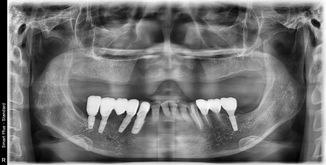 약수동 치과, 전체틀니 오래 쓰신분들 전체 임플란트 가능한가요??(치조골의 흡수양상과 모양) 관련 이미지 1