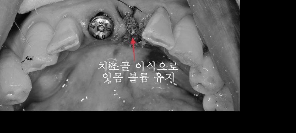 성동구 옥수동 치과 앞니 임플란트수술 즉시 임시치아 제작(구강스캐너를 이용한 수술절차) 관련 이미지 5