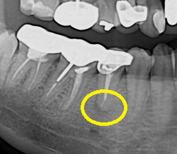 약수역 치과 오래된 신경치료 다시 하기 관련 이미지 2